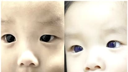 കോവിഡ് പ്രതിരോധ ചികിത്സ; ആറുമാസം പ്രായമുള്ള കുഞ്ഞിന്റെ കണ്ണുകളുടെ നിറം മാറി !