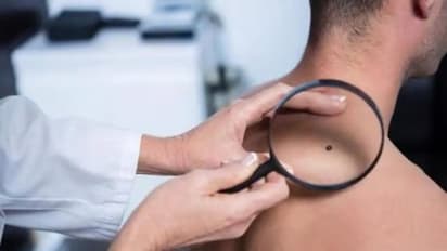 മെലനോമ; അറിയാം കാരണങ്ങൾ, ലക്ഷണങ്ങൾ, പ്രതിരോധം...