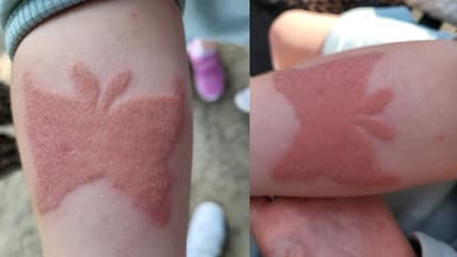 കയ്യില് ഹെന്ന ടാറ്റൂ ചെയ്ത ഏഴുവയസുകാരിക്ക് സംഭവിച്ചത്; ചിത്രങ്ങള് പങ്കുവച്ച് അമ്മ