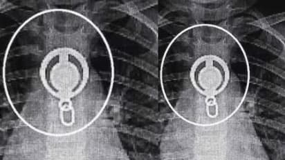 കട്ടപ്പനയിൽ 3 വയസ്സുകാരി ലോക്കറ്റ് വിഴുങ്ങി, അന്നനാളത്തിൽ കുടുങ്ങി; ശസ്ത്രക്രിയ കൂടാതെ പുറത്തെടുത്ത് ഡോക്ടർമാർ
