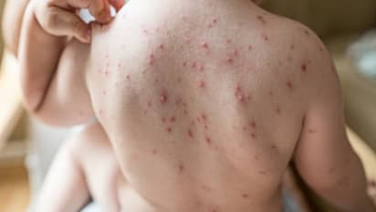 chickenpox