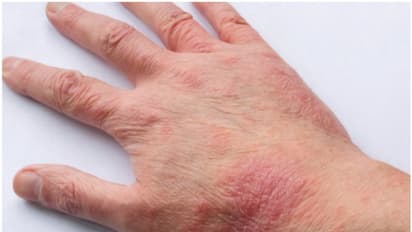  10,000-ത്തിലധികം കേസുകളും ബാധിച്ചത് 12 വയസിന് താഴെയുള്ള കുട്ടികളിൽ; അറ്റോപിക് എക്‌സിമ അറിയിപ്പുമായി കുവൈത്ത്