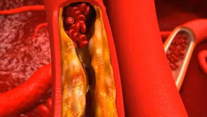 കൊളസ്ട്രോളിനെ എങ്ങനെ നിയന്ത്രിക്കാം? തിരിച്ചറിയണം ഈ അപകടസാധ്യതകൾ...