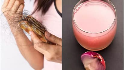 തലമുടി കൊഴിച്ചിലും താരനും അകറ്റാന്‍ പരീക്ഷിക്കാം ഉള്ളി കൊണ്ടുള്ള ഹെയര്‍ പാക്കുകള്‍... 