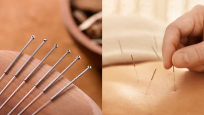 അക്യുപങ്ചര്‍ സൂചി ഉപയോഗിച്ചതിലെ പിഴവ്, ശ്വാസകോശം ചുരുങ്ങി കുഴഞ്ഞ് വീണ് 63കാരി ഗുരുതരാവസ്ഥയിൽ, കേസ് 