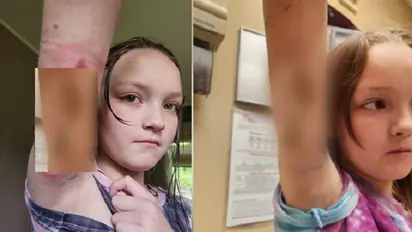 9 साल की लड़की को चुटकी काटने जैसा दर्द, एक मकड़ी से फैला यह भयंकर इंफेक्शन