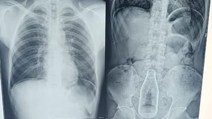 வெளியேறிய ரத்தம்.. நபரின் வயிற்றில் இருந்த குளிர்பான பாட்டில்.. எப்படி உள்ளே சென்றது? வெளியான அதிர்ச்சி தகவல்!