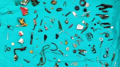 நோயாளி வயிற்றுக்குள் இயர்போன்கள்.. இரும்பு பொருட்கள்.. ஆடிப்போன மருத்துவர்கள் - பதறவைக்கும் சம்பவம்