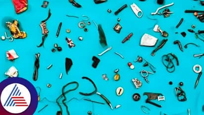 ಹೊಟ್ಟೆನಾ... ಗುಜರಿ ಅಂಗಡಿನಾ? ಹೊಟ್ಟೆಯೊಳಗಿದ್ದ ನೂರಕ್ಕೂ ಹೆಚ್ಚು ವಸ್ತು ನೋಡಿ ವೈದ್ಯರೇ ಶಾಕ್!