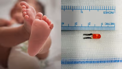 షాకింగ్.. ఏడునెలల చిన్నారి ఊపిరితిత్తుల్లో ఒకటిన్నర సెంటీమీటర్ల ఎల్ఈడి బల్బు..