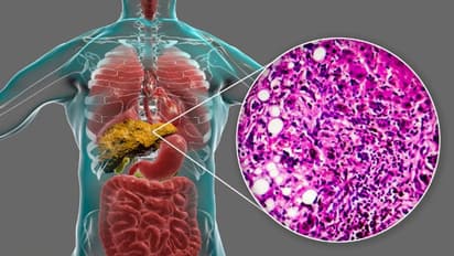 ഇവ കഴിച്ചോളൂ, ഫാറ്റി ലിവർ തടയാം