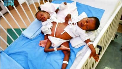 ടാൻസാനിയൻ സയാമീസ് ഇരട്ടകളെ വേർപ്പെടുത്താൻ റിയാദിൽ ശസ്ത്രക്രിയ