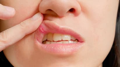 വായ്പ്പുണ്ണിനെ തടയാന്‍ ഡയറ്റില്‍ നിന്നും ഒഴിവാക്കേണ്ട ഭക്ഷണങ്ങളും വീട്ടില്‍ പരീക്ഷിക്കാവുന്ന കാര്യങ്ങളും... 