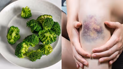 വിറ്റാമിന്‍ കെയുടെ കുറവ്; ഡയറ്റില്‍ ഉള്‍പ്പെടുത്താം ഈ പത്ത് ഭക്ഷണങ്ങള്‍...