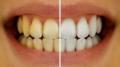 ಹಳದಿ ಹಲ್ಲನ್ನು ಬೆಳ್ಳಗಾಗಿಸಿ ಆಕರ್ಷಕ ನಗು ನಿಮ್ಮದಾಗಿಸಲು ಈ ಪುಡಿ ಬಳಸಿ