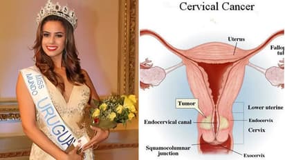 Carvical cancer