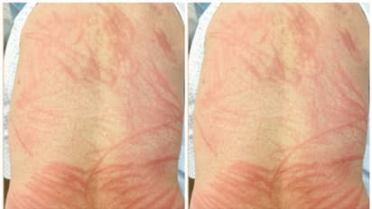 മഷ്റൂം കഴിച്ചു; രണ്ട് ദിവസത്തിന് ശേഷം മുതുകില് അടിച്ചത് പോലുള്ള ചുവന്ന പാടുകളും അസഹമായ വേദനയും !