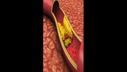 கொலஸ்ட்ரால் டக்குனு குறைய சூப்பரான வீட்டு வைத்தியம் இதோ..!!