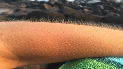 உடலில் புல்லரிப்பு ஏற்படுவதற்கான காரணம் என்ன தெரியுமா?