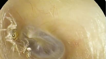 ബിപി കൂടി എത്തിയ സ്ത്രീയുടെ ചെവിക്കകത്ത് ജീവനുള്ള എട്ടുകാലി; വീഡിയോ...