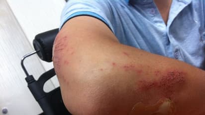 ಯಾವುದೇ ಕಾರಣ ಇಲ್ಲದೇ ದೇಹದ ಮೇಲೆ ಗಾಯದ ಗುರುತು ಕಾಣಿಸೋದು ಯಾಕೆ? 