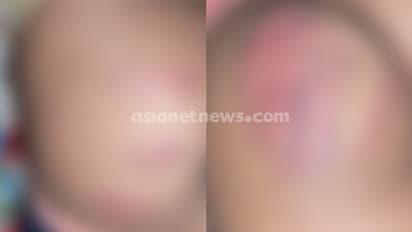 ഹോം വർക്കിന്റെ പേരിൽ കൊല്ലത്ത് ആറാം ക്ലാസുകാരനെ ട്യൂഷൻ ടീച്ചർ ക്രൂരമായി തല്ലി; പരാതി നൽകി മാതാപിതാക്കൾ