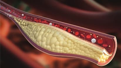 കൊളസ്ട്രോൾ കുറയ്ക്കണോ? എങ്കിൽ ഈ ഭക്ഷണം ഡയറ്റിൽ ഉൾപ്പെടുത്തി കൊള്ളൂ