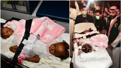 സൽമാൻ രാജാവിന്റെയും കിരീടാവകാശിയുടെയും നിര്ദ്ദേശം; ശസ്ത്രക്രിയക്കായി നൈജീരിയൻ സയാമീസ് ഇരട്ടകള് റിയാദില്