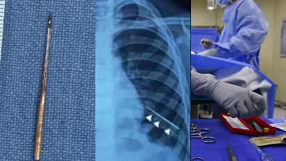 കുട്ടിക്ക് പനി, രക്തം ഛർദിച്ചു, പരിശോധിച്ചപ്പോൾ ശ്വാസകോശത്തിൽ സൂചി! പുറത്തെടുത്തത് കാന്തം ഉപയോഗിച്ച്