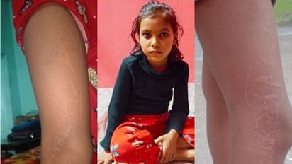 Viral: ಬಾಲಕಿಯ ಮೈಮೇಲೆ ಮೂಡುತ್ತಿದೆ ರಾಮ್, ರಾಧೆಯ ಹೆಸರು, ವೈದ್ಯಲೋಕಕ್ಕೆ ಅಚ್ಚರಿ!