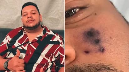 മുഖത്ത് എട്ടുകാലിയുടെ കടിയേറ്റു; ദിവസങ്ങള്ക്കകം ഗായകന് ദാരുണാന്ത്യം