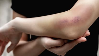 വിറ്റാമിന് കെയുടെ കുറവ്; ഈ ലക്ഷണങ്ങളെ ശ്രദ്ധിക്കാതെ പോകരുതേ...