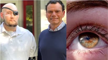 അങ്ങനെ അതും സാധ്യം; കണ്ണ് പൂർണമായി മാറ്റിവെക്കല്‍ ശസ്ത്രക്രിയ പൂര്‍ത്തിയാക്കി, മെഡിക്കൽ സയൻസിന് അപൂർവ നേട്ടം