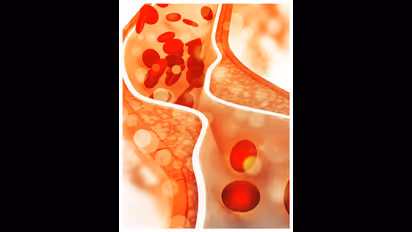 മോശം കൊളസ്ട്രോൾ കുറയ്ക്കണോ ? ഇക്കാര്യങ്ങള്‍ മനസില്‍ സൂക്ഷിച്ചോളൂ