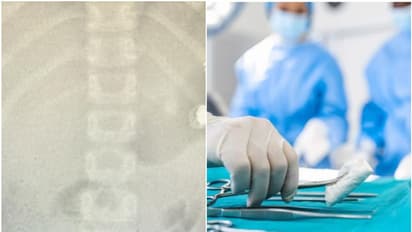 അമ്മയോട് മൊബൈല്‍ ഫോൺ ചോദിച്ചിട്ട് കൊടുത്തില്ല, പിന്നാലെ അസ്വസ്ഥത; എക്സ്റേ, 10 വയസ്സുകാരൻ വിഴുങ്ങിയത് ഇയര്‍ ബഡ്