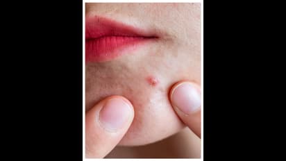 మొటిమలు తగ్గాలంటే ఏం చేయాలి? 