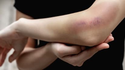 വിറ്റാമിൻ കെയുടെ കുറവ്; ശരീരം കാണിക്കുന്ന ഈ ലക്ഷണങ്ങളെ തിരിച്ചറിയാം...