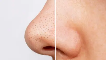 മൂക്കിന് ചുറ്റുമുള്ള ബ്ലാക്ക്ഹെഡ്സ് അകറ്റാന് വീട്ടില് പരീക്ഷിക്കാം ഈ പൊടിക്കൈകള്...