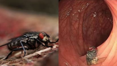 63കാരന്‍റെ വൻകുടലിന്‍റെ ഭിത്തിയിൽ പരിക്കുകളില്ലാതെ ഈച്ച, അമ്പരന്ന് ആരോഗ്യ വിദഗ്ധർ