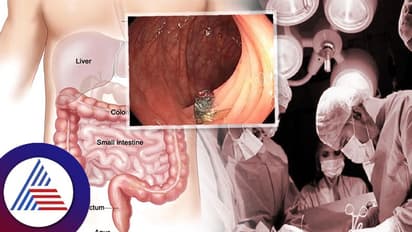 ಹೋಗಿದ್ದು ಕ್ಯಾನ್ಸರ್ ಪರೀಕ್ಷೆಗೆ, ಹೊಟ್ಟೇಲಿದ್ದ ಜೀವಂತ ಕೀಟ ನೋಡಿ ಡಾಕ್ಟರ್ಸ್ ಶಾಕ್!