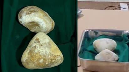 ഓച്ചിറ സ്വദേശി എത്തിയത് അടിവയര് വേദനയുമായി; സ്കാനിൽ കണ്ടത് അര കിലോയുള്ള കല്ല്, 1 മണിക്കൂര് ശസ്ത്രക്രിയ