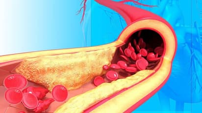 40 കഴിഞ്ഞ സ്ത്രീകളിൽ മോശം കൊളസ്ട്രോൾ ഉണ്ടാകാനുള്ള 5 കാരണങ്ങൾ