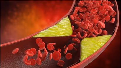 ഈ ആറ് ഭക്ഷണങ്ങള് മാത്രം മതി, ചീത്ത കൊളസ്ട്രോളിനെ കുറയ്ക്കാം...
