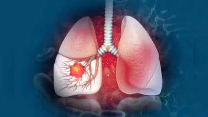 വൈറ്റ് ലങ് സിൻഡ്രോം; അറിഞ്ഞിരിക്കാം ഈ ലക്ഷണങ്ങളെ...