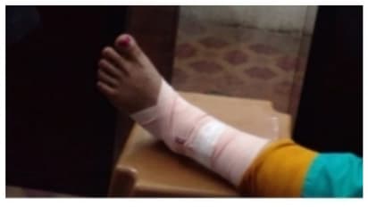 നടന്നുപോകുമ്പോൾ കാൽ സ്ലാബിനടിയിൽ കുടുങ്ങി യുവതിക്ക് ഗുരുതര പരിക്ക്, ഉത്തരവാദി പിഡബ്ല്യുഡിയെന്ന് നാട്ടുകാർ