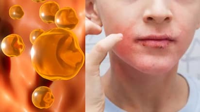 Health Tips: ചീത്ത കൊളസ്ട്രോള് ഉണ്ടോ? മുഖത്ത് പ്രകടമാകുന്ന ഈ ലക്ഷണങ്ങളെ തിരിച്ചറിയാം...