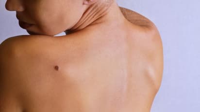 മെലനോമ; തിരിച്ചറിയാം ഈ ലക്ഷണങ്ങളെ...