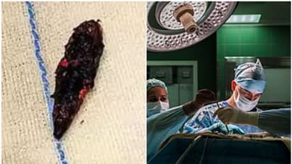 തലയ്ക്കകത്ത് വെടിയുണ്ടയുമായി 18 വർഷം ജീവിതം, ഒടുവിൽ വിദേശ യുവാവിന് ബെം​ഗളൂരുവിൽ ആശ്വാസം, ശസ്ത്രക്രിയ വിജയം!