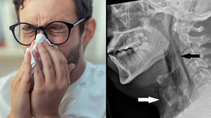 மிக மிக அரிய நிகழ்வு.. தும்மலை அடக்க முயன்ற நபருக்கு மூச்சுக்குழாயில் ஏற்பட்ட விபரீதம்.. என்ன நடந்தது?