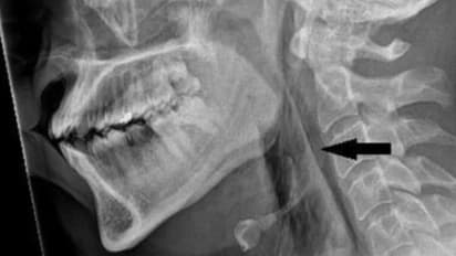 Do you have habit of holding in your sneezes? Man tears his windpipe in the attempt!